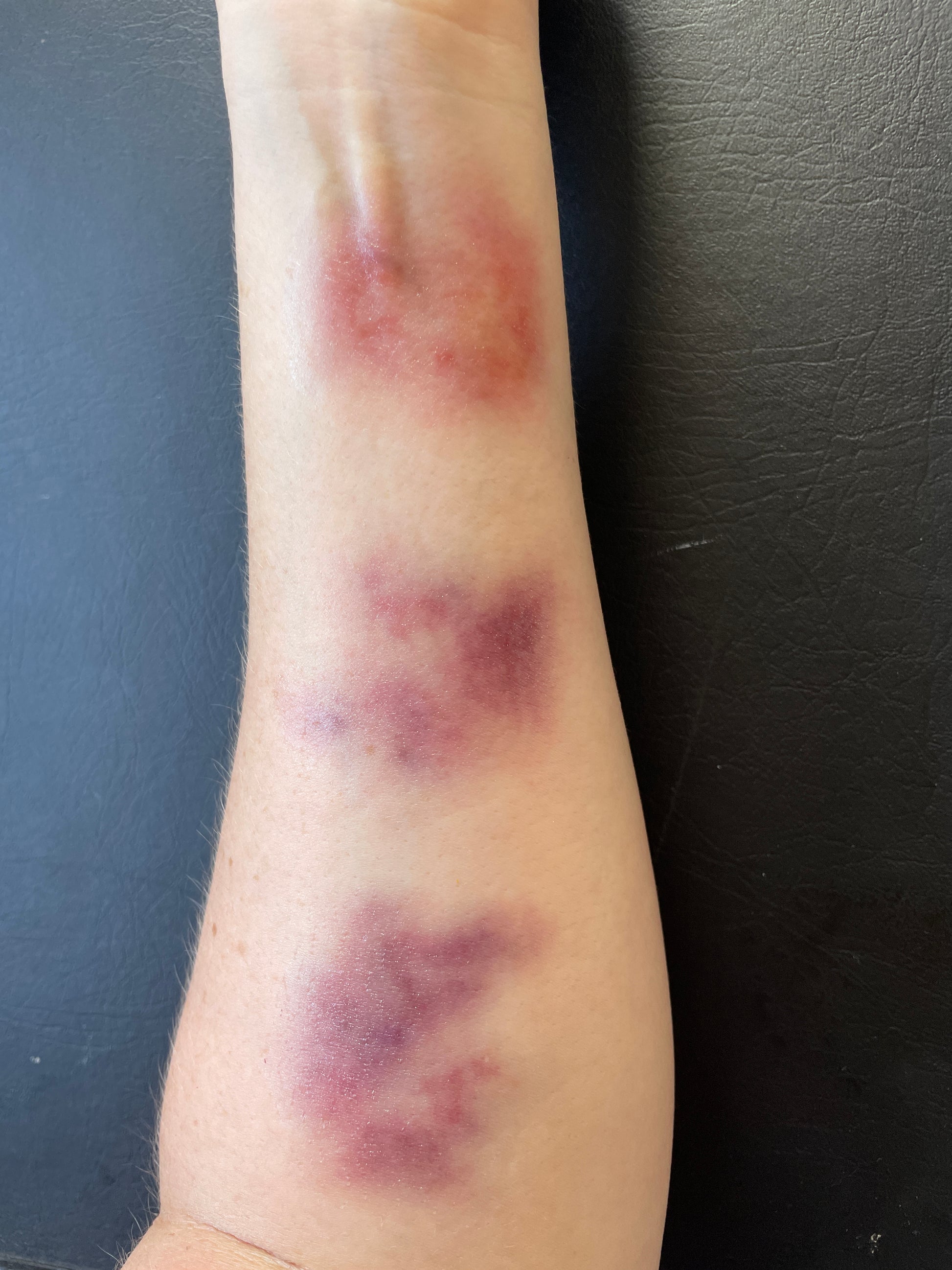 Bruising - Fresh Medium Size, Pale - Medium Skin Tone