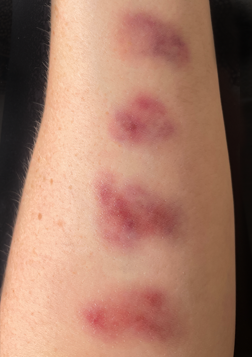 Bruising - Fresh Small Size, Pale - Medium Skin Tone