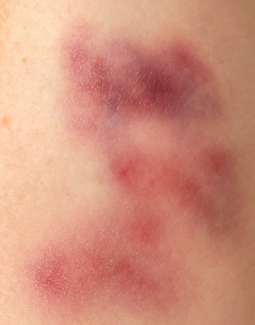 Bruising - Fresh Small Size, Pale - Medium Skin Tone