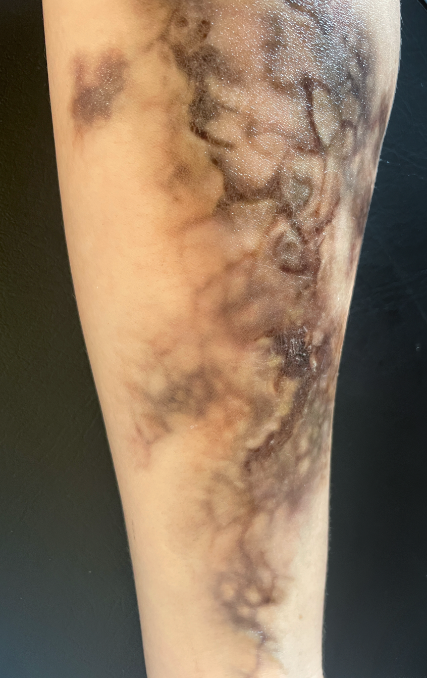 Bruising - zombie skin