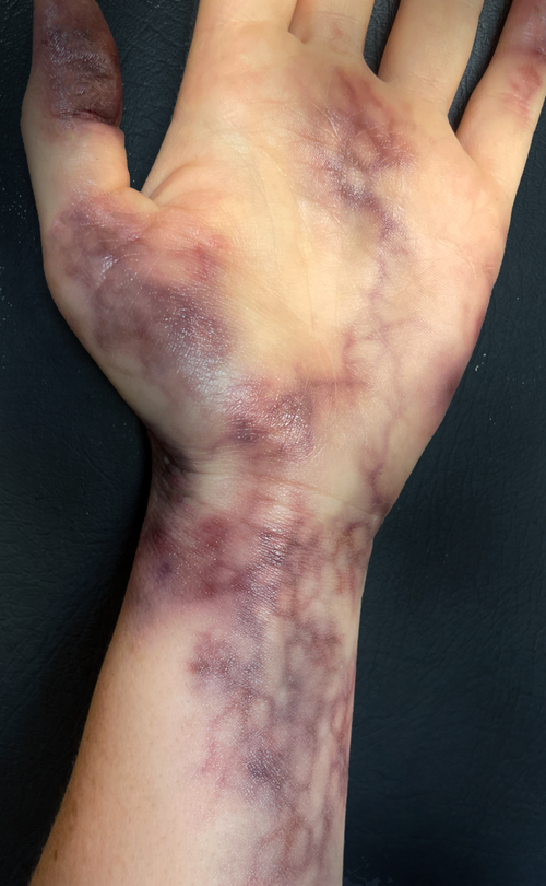 Image shown here shows only tattoos. Two Lividity bruising pages were used to create this.