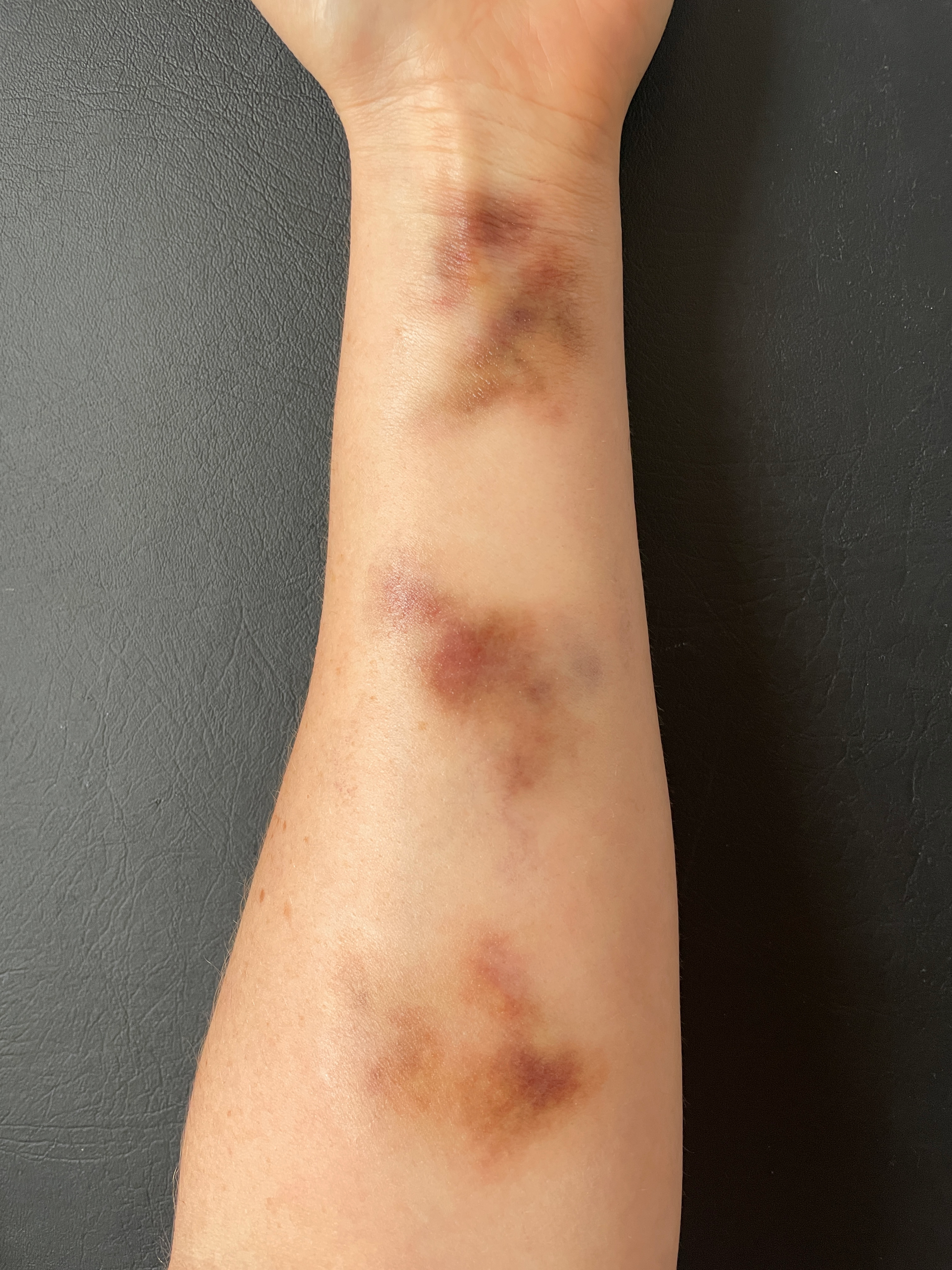 Bruising - Aged Medium Size, Pale - Medium Skin Tone
