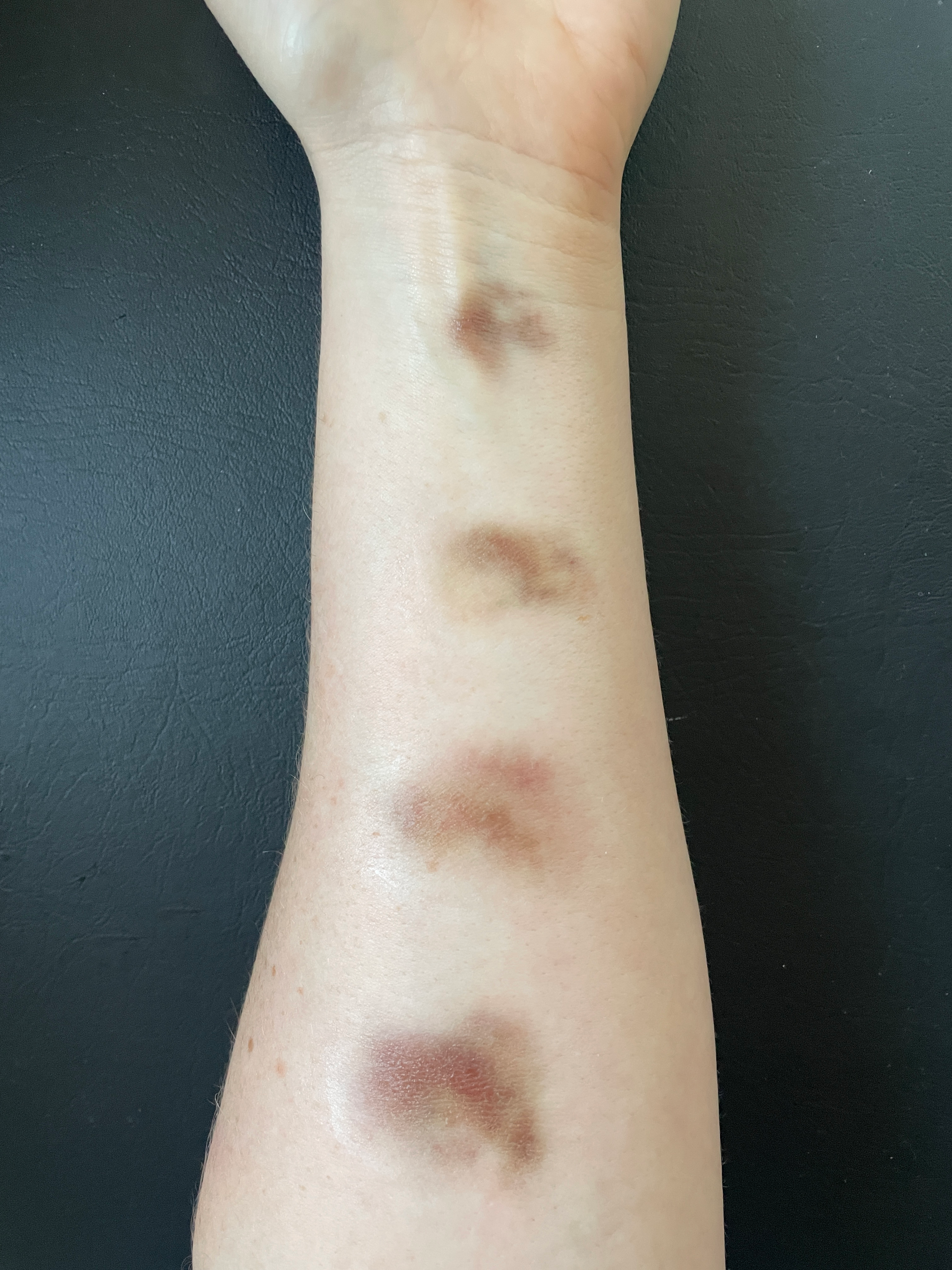 Bruising - Aged Small Size, Pale - Medium Skin Tone