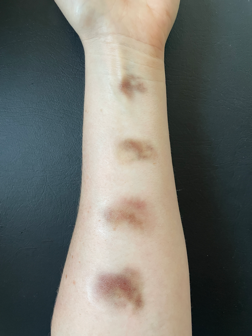 Bruising - Aged Small Size, Pale - Medium Skin Tone
