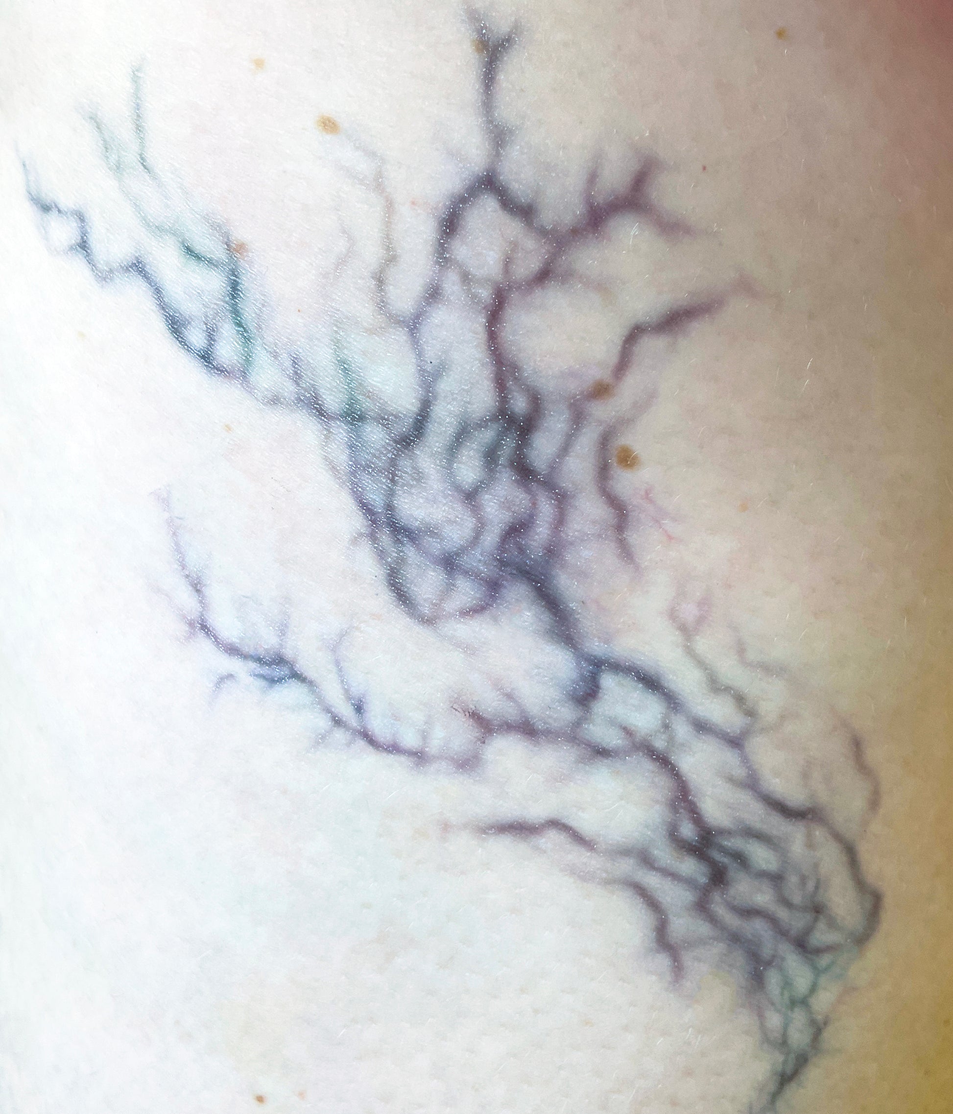 Veins - Infected